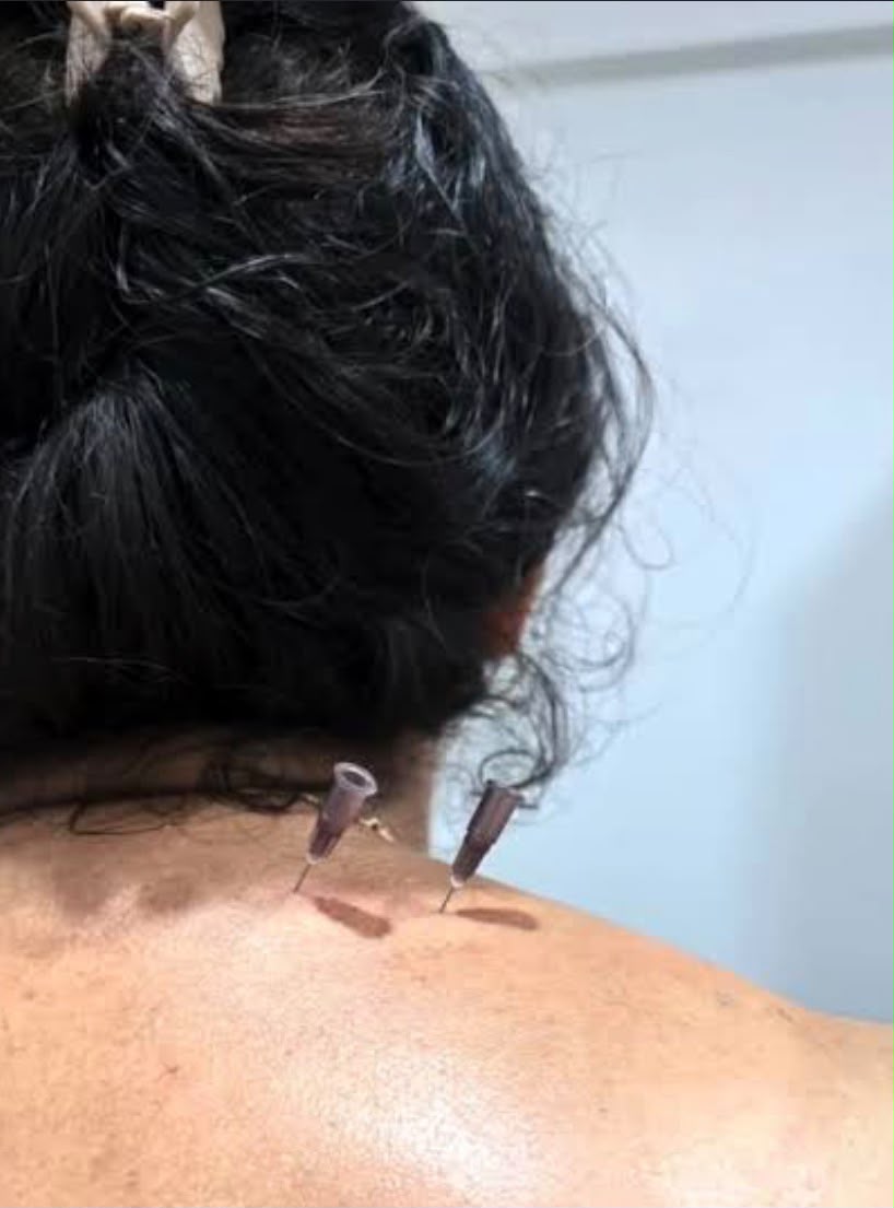 Viddha Karma acupuncture